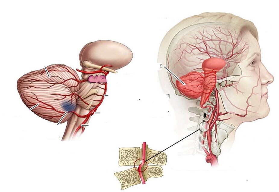 Creebellar Ischemia